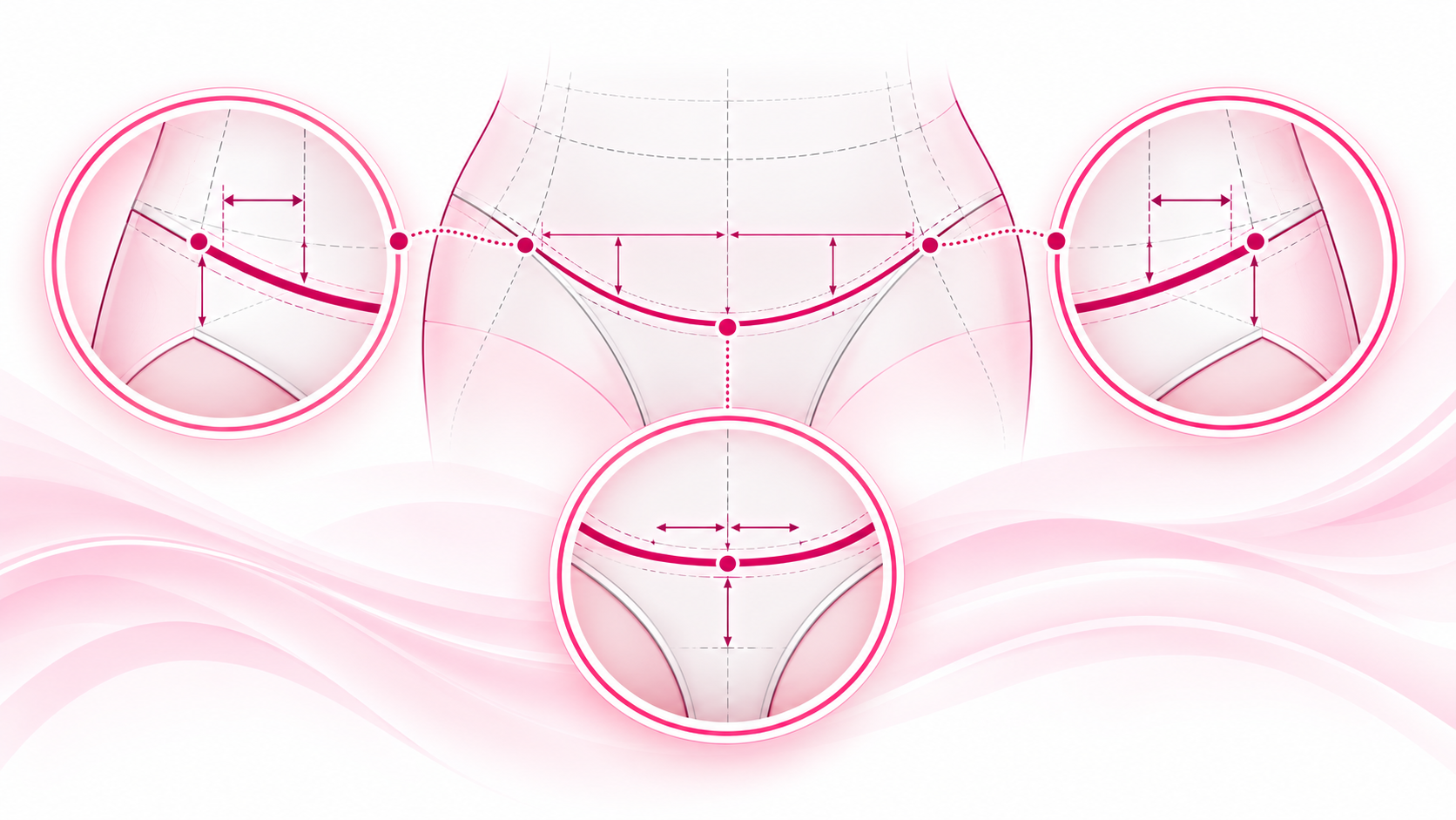 Planificación de la ubicación de la cicatriz de lipoabdominoplastia