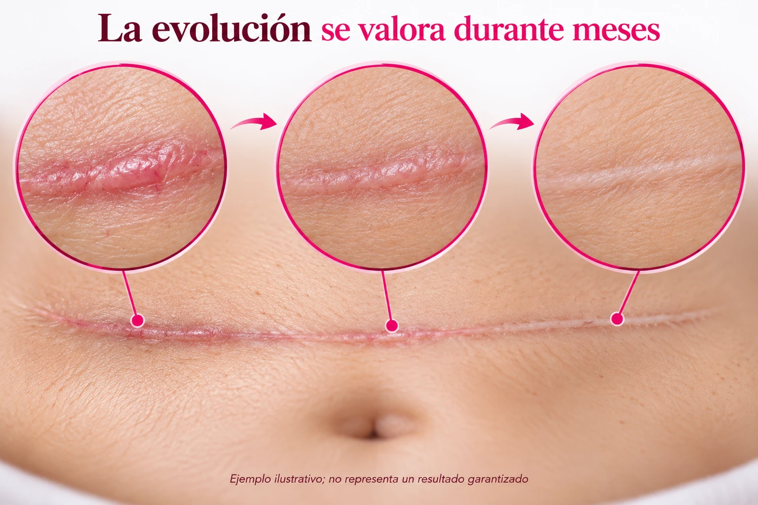 Cambios de color y relieve de una cicatriz abdominal durante meses