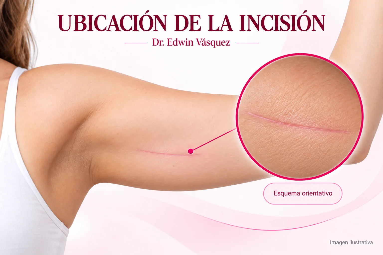 Ubicación ilustrativa de la incisión en la cara interna del brazo — imagen ilustrativa