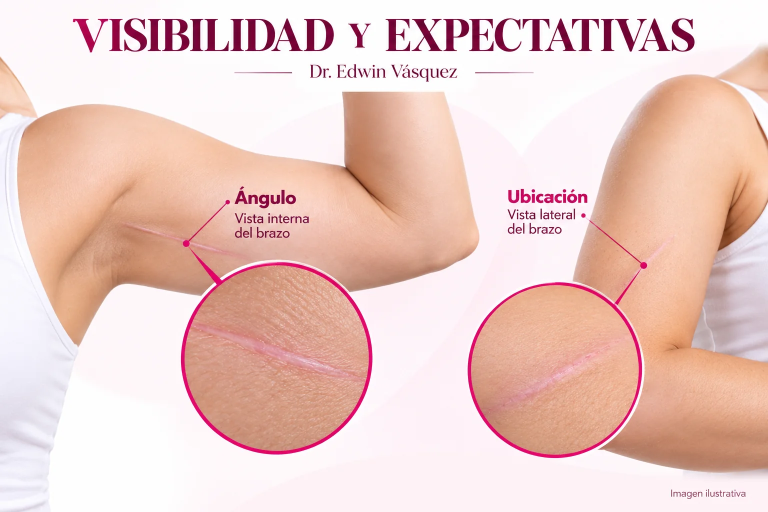 Dos ángulos ilustrativos para explicar la visibilidad de la cicatriz del brazo — imagen ilustrativa