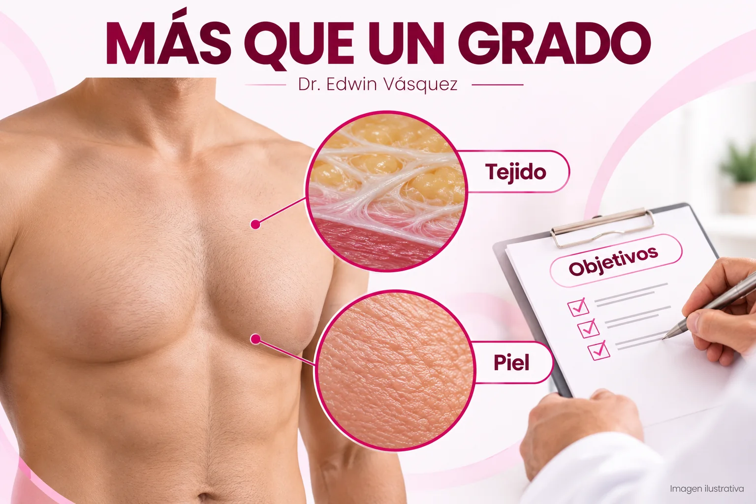 Ilustración de tejido mamario y piel en la valoración de ginecomastia — imagen ilustrativa