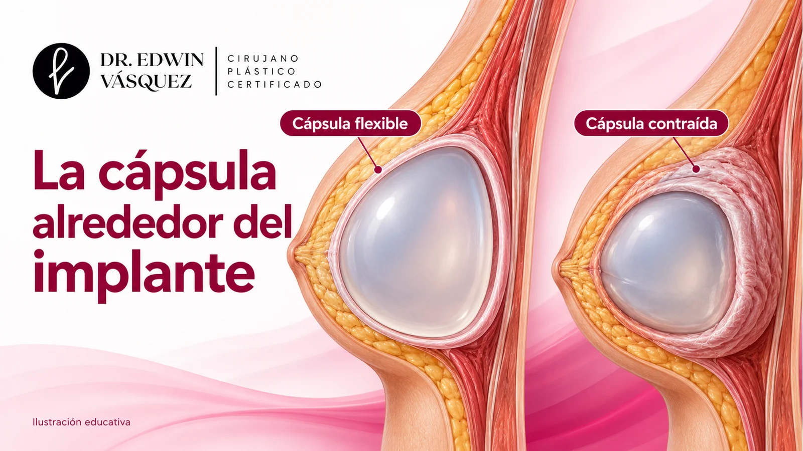 Comparación educativa de una cápsula flexible y una cápsula contraída alrededor de un implante mamario.