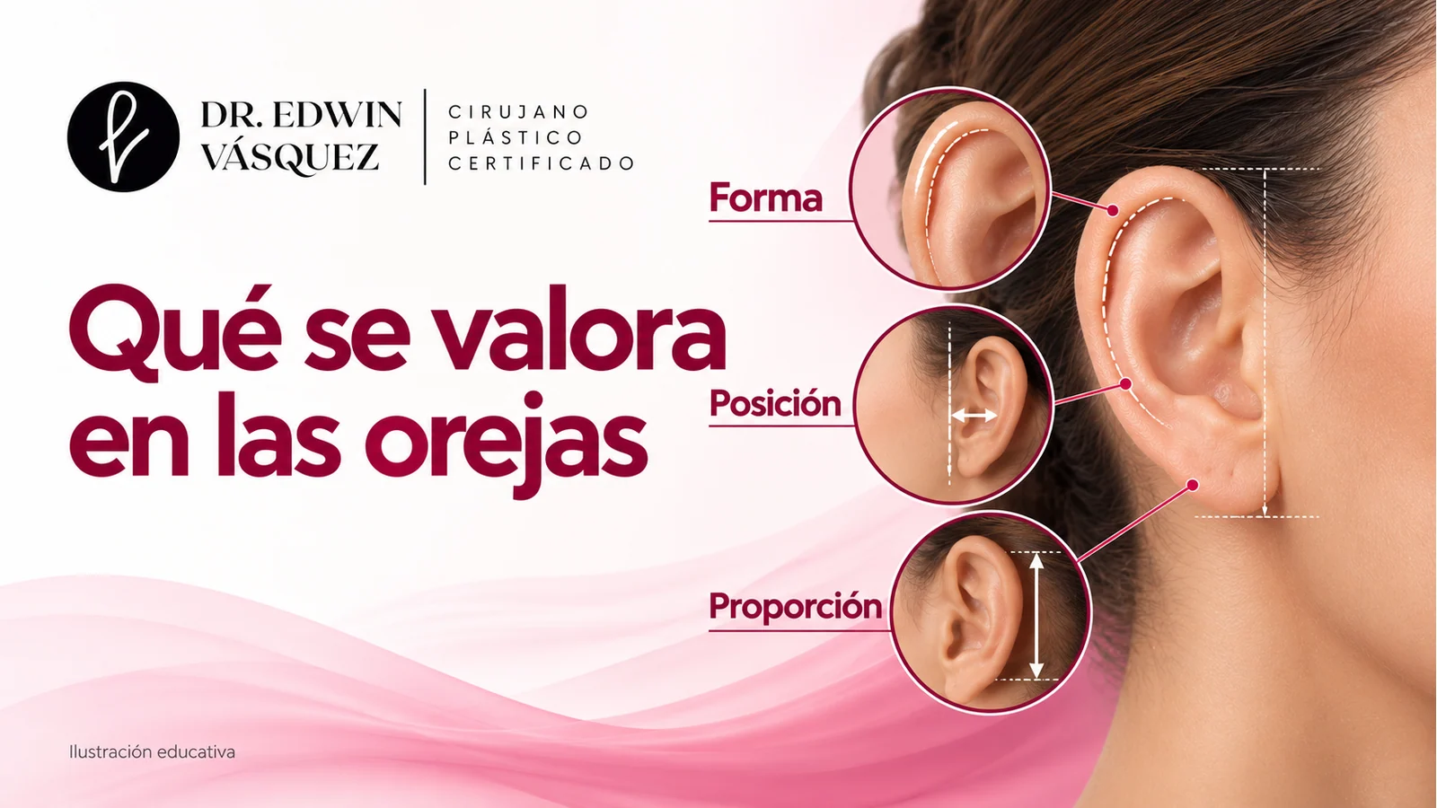 Modelo de oreja con referencias educativas de forma, posición y proporción para valorar una otoplastia.