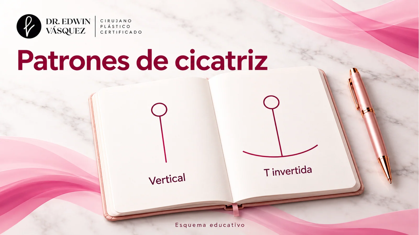Esquema simbólico de dos patrones de cicatriz: vertical y en T invertida, trazados sobre un cuaderno educativo.