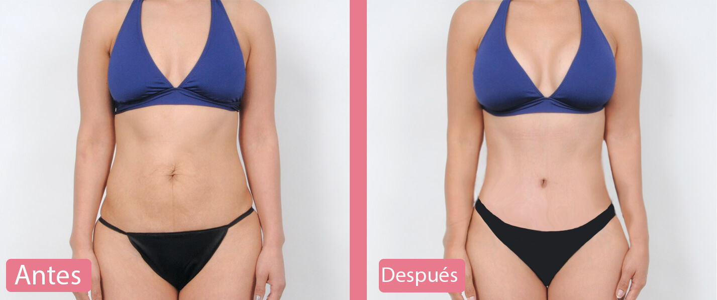 La vida después de un Mommy Makeover